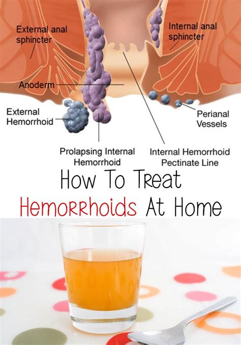 does hemorrhoids leak|Hemorrhoids Leaking Clear Fluid: What You Need To Know